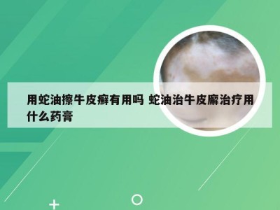 用蛇油擦牛皮癣有用吗 蛇油治牛皮廨治疗用什么药膏