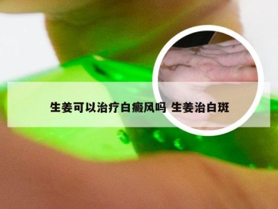 生姜可以治疗白癜风吗 生姜治白斑