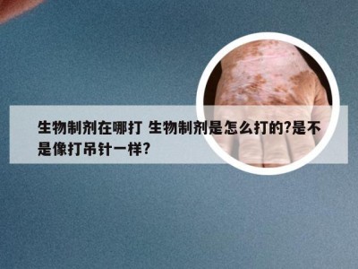 生物制剂在哪打 生物制剂是怎么打的?是不是像打吊针一样?