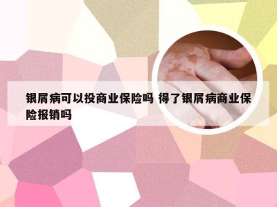 银屑病可以投商业保险吗 得了银屑病商业保险报销吗