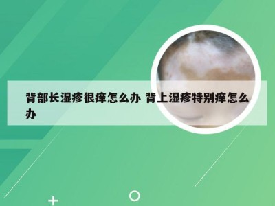 背部长湿疹很痒怎么办 背上湿疹特别痒怎么办