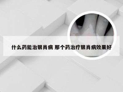 什么药能治银肖病 那个药治疗银肖病效果好