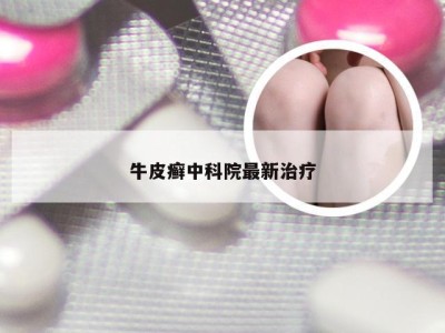 牛皮癣中科院最新治疗