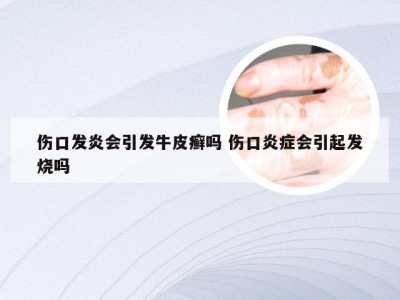 伤口发炎会引发牛皮癣吗 伤口炎症会引起发烧吗