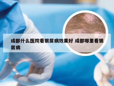 成都什么医院看银屑病效果好 成都哪里看银屑病