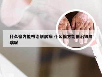 什么偏方能根治银屑病 什么偏方能根治银屑病呢