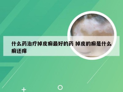 什么药治疗掉皮癣最好的药 掉皮的癣是什么癣还痒