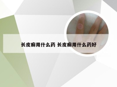 长皮癣用什么药 长皮癣用什么药好