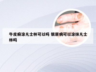 牛皮癣涂凡士林可以吗 银屑病可以涂抹凡士林吗