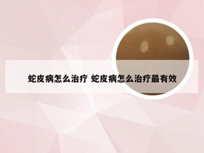 蛇皮病怎么治疗 蛇皮病怎么治疗最有效