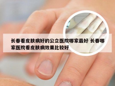 长春看皮肤病好的公立医院哪家最好 长春哪家医院看皮肤病效果比较好