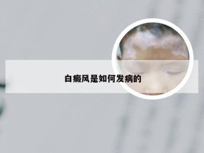 白癜风是如何发病的