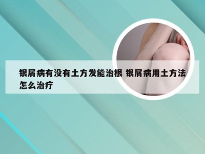 银屑病有没有土方发能治根 银屑病用土方法怎么治疗