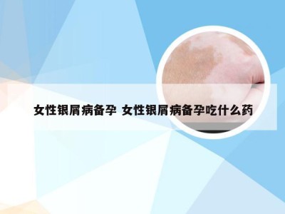 女性银屑病备孕 女性银屑病备孕吃什么药