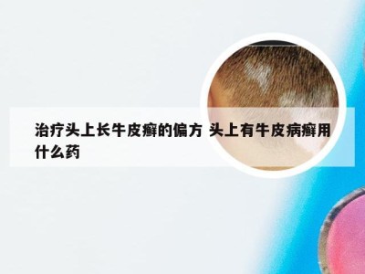 治疗头上长牛皮癣的偏方 头上有牛皮病癣用什么药