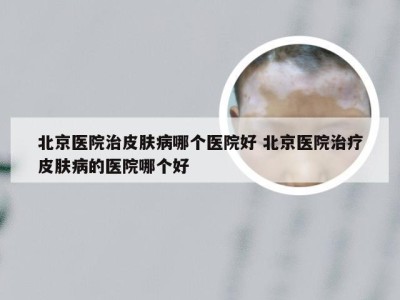 北京医院治皮肤病哪个医院好 北京医院治疗皮肤病的医院哪个好