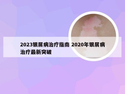 2023银屑病治疗指南 2020年银屑病治疗最新突破