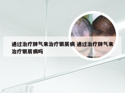 通过治疗肺气来治疗银屑病 通过治疗肺气来治疗银屑病吗