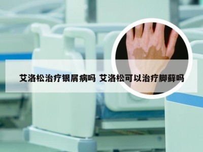 艾洛松治疗银屑病吗 艾洛松可以治疗脚藓吗