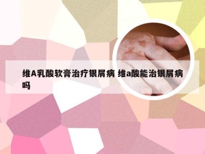 维A乳酸软膏治疗银屑病 维a酸能治银屑病吗