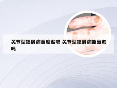 关节型银屑病百度贴吧 关节型银屑病能治愈吗