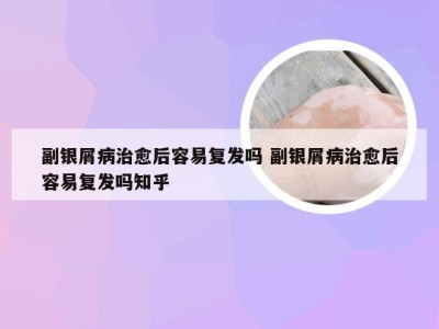 副银屑病治愈后容易复发吗 副银屑病治愈后容易复发吗知乎