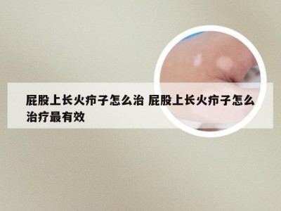 屁股上长火疖子怎么治 屁股上长火疖子怎么治疗最有效