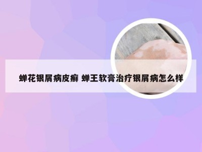 蝉花银屑病皮癣 蝉王软膏治疗银屑病怎么样