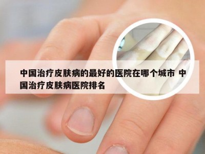 中国治疗皮肤病的最好的医院在哪个城市 中国治疗皮肤病医院排名