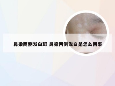 鼻梁两侧发白斑 鼻梁两侧发白是怎么回事