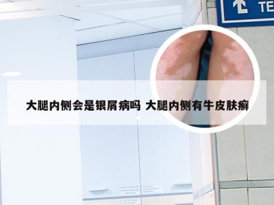 大腿内侧会是银屑病吗 大腿内侧有牛皮肤癣