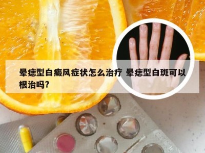 晕痣型白癜风症状怎么治疗 晕痣型白斑可以根治吗?