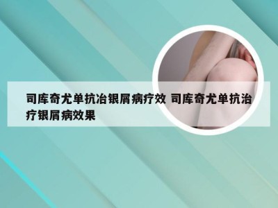 司库奇尤单抗冶银屑病疗效 司库奇尤单抗治疗银屑病效果