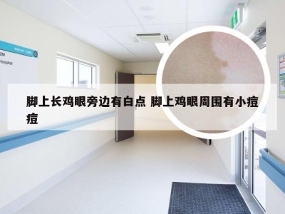 脚上长鸡眼旁边有白点 脚上鸡眼周围有小痘痘