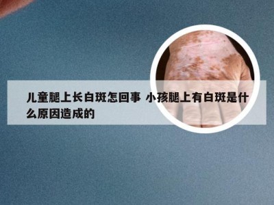 儿童腿上长白斑怎回事 小孩腿上有白斑是什么原因造成的