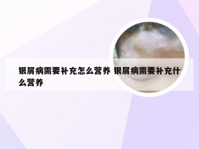 银屑病需要补充怎么营养 银屑病需要补充什么营养