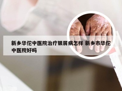 新乡华佗中医院治疗银屑病怎样 新乡市华佗中医院好吗