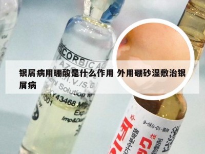 银屑病用硼酸是什么作用 外用硼砂湿敷治银屑病