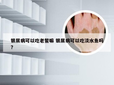 银屑病可以吃老鳖嘛 银屑病可以吃淡水鱼吗?