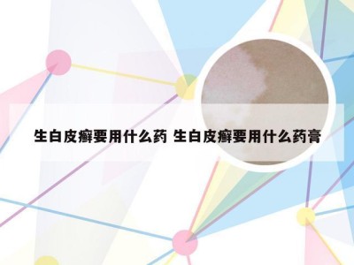 生白皮癣要用什么药 生白皮癣要用什么药膏