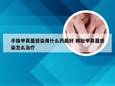 手指甲真菌感染用什么药最好 脚趾甲真菌感染怎么治疗