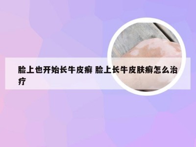 脸上也开始长牛皮癣 脸上长牛皮肤癣怎么治疗