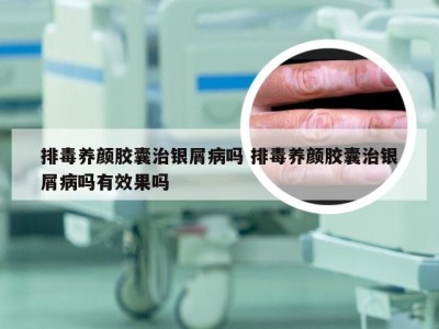 排毒养颜胶囊治银屑病吗 排毒养颜胶囊治银屑病吗有效果吗