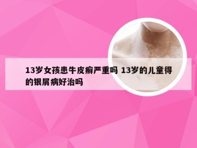 13岁女孩患牛皮癣严重吗 13岁的儿童得的银屑病好治吗