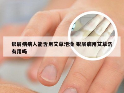 银屑病病人能否用艾草泡澡 银屑病用艾草洗有用吗