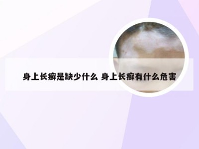 身上长癣是缺少什么 身上长癣有什么危害