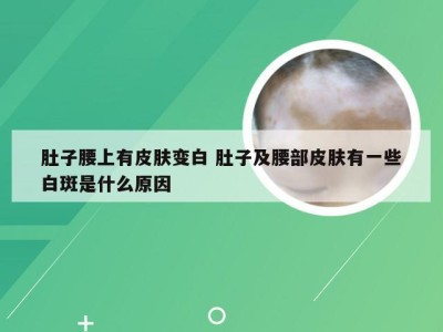 肚子腰上有皮肤变白 肚子及腰部皮肤有一些白斑是什么原因