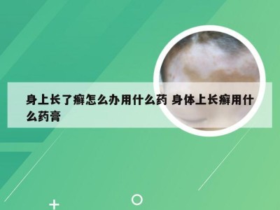 身上长了癣怎么办用什么药 身体上长癣用什么药膏