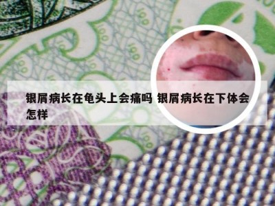 银屑病长在龟头上会痛吗 银屑病长在下体会怎样