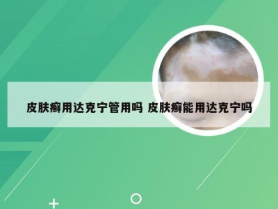 皮肤癣用达克宁管用吗 皮肤癣能用达克宁吗